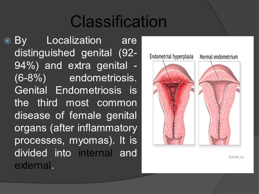 Classification By Localization are distinguished genital (92-94%) and extra genital -(6-8%) endometriosis. Genital Endometriosis